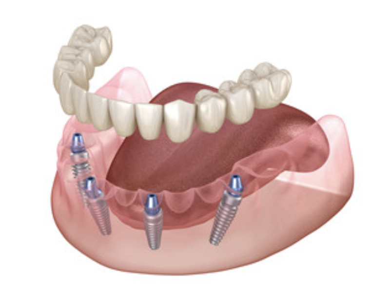 All-on-4® implant dentures