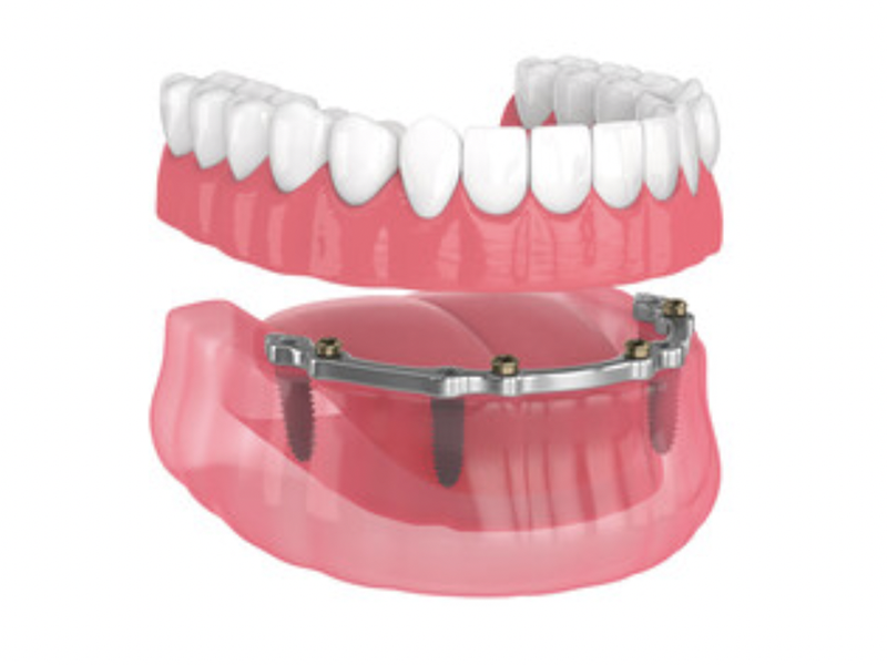 Bar attachment overdenture