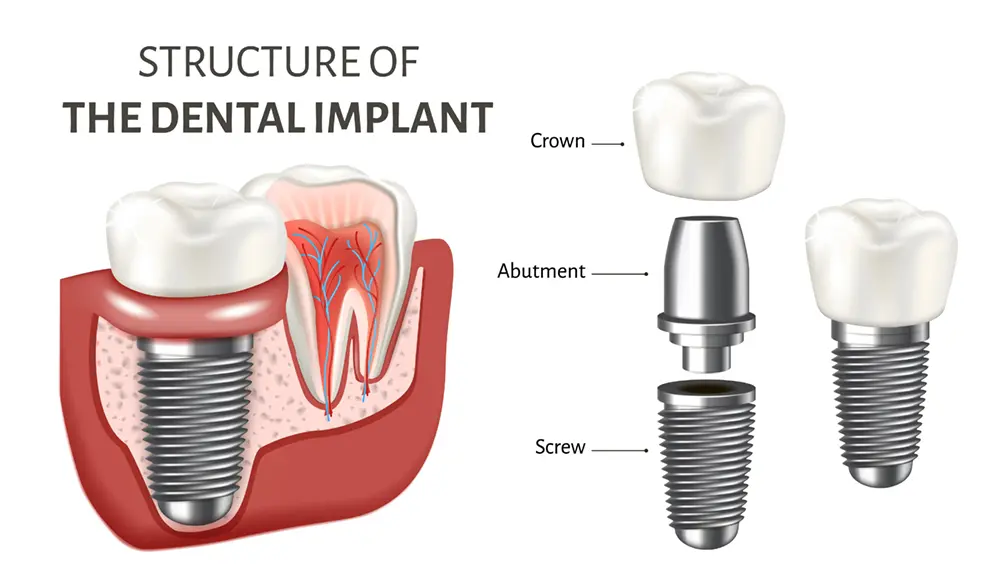 Main Parts of a Dental Implant