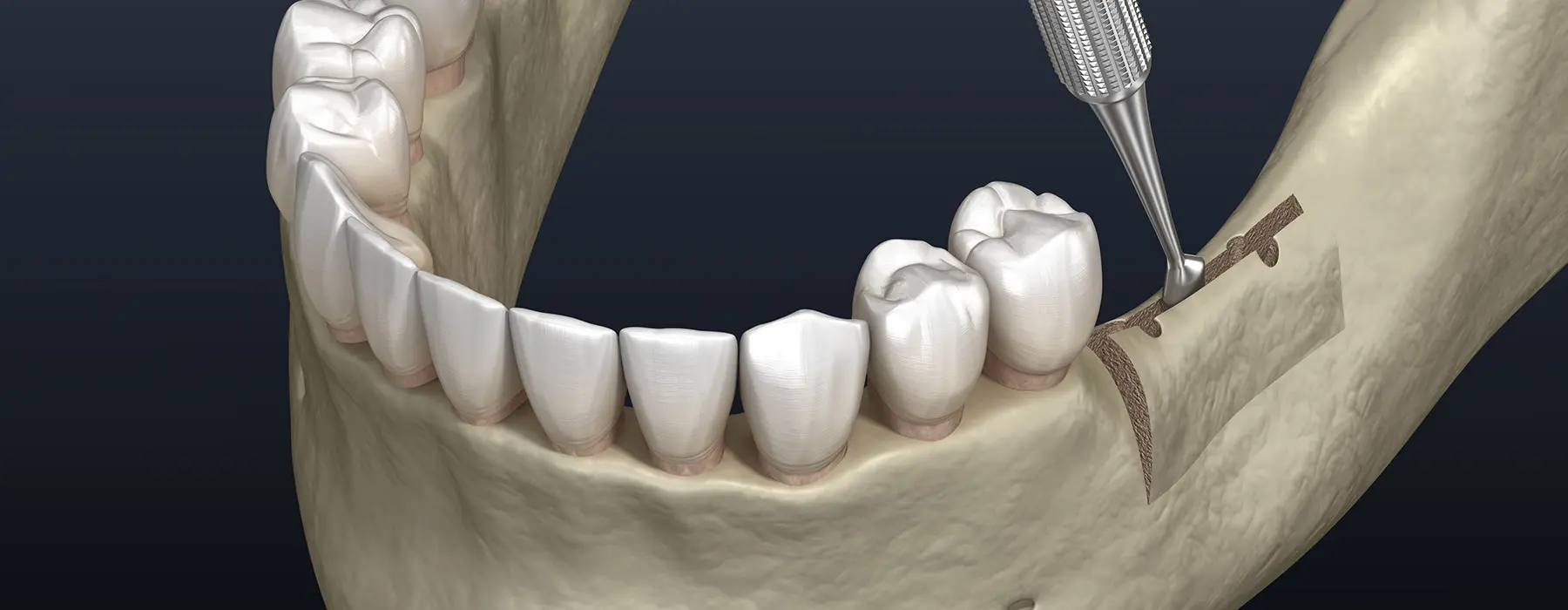 Ridge Augmentation: The Key to Successful Dental Implants