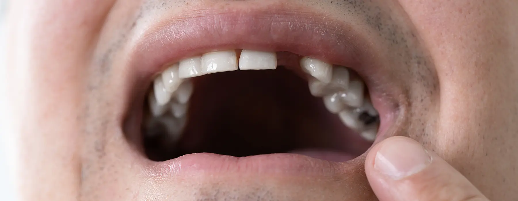 Missing Teeth? Explore Modern Tooth Replacement Options