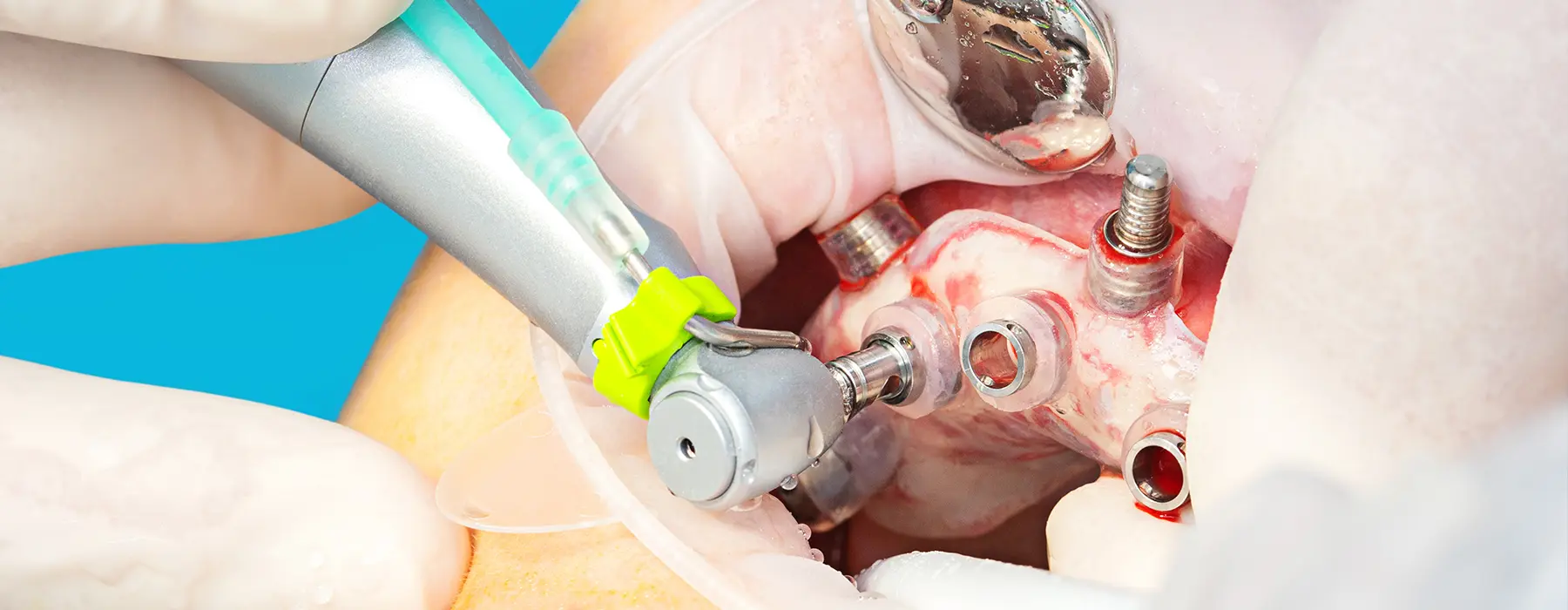 Guided Implant Surgery: The Future of Dental Implants