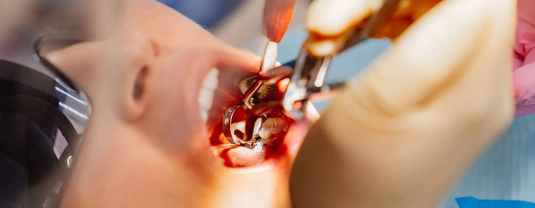 How Long Does Wisdom Teeth Surgery Take?