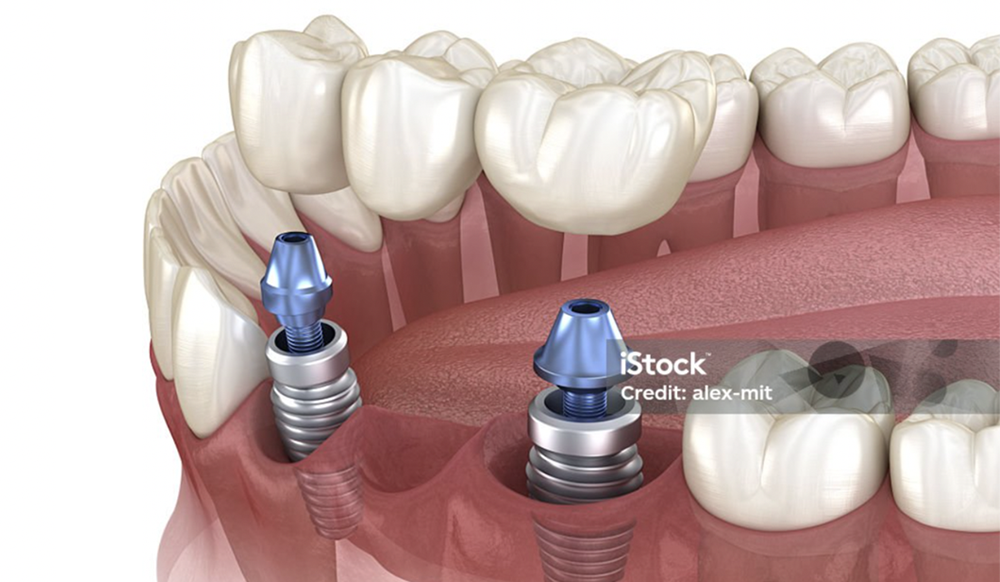 Implant-Supported Bridge