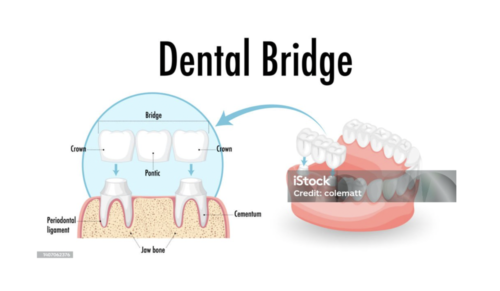 Dental Bridge
