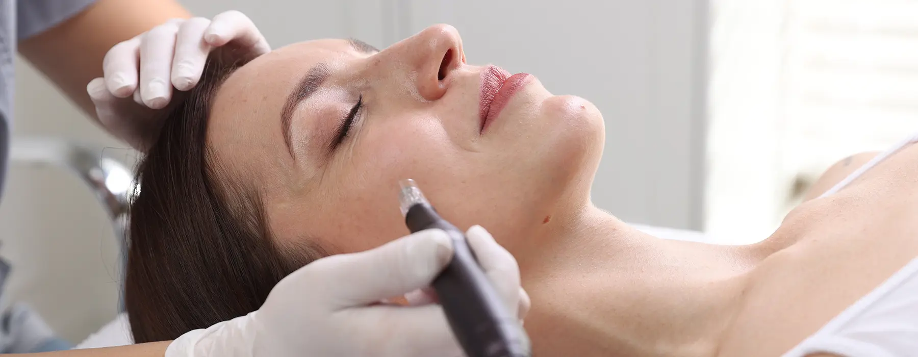 Planning Your Microneedling Treatments for Maximum Skin Improvement