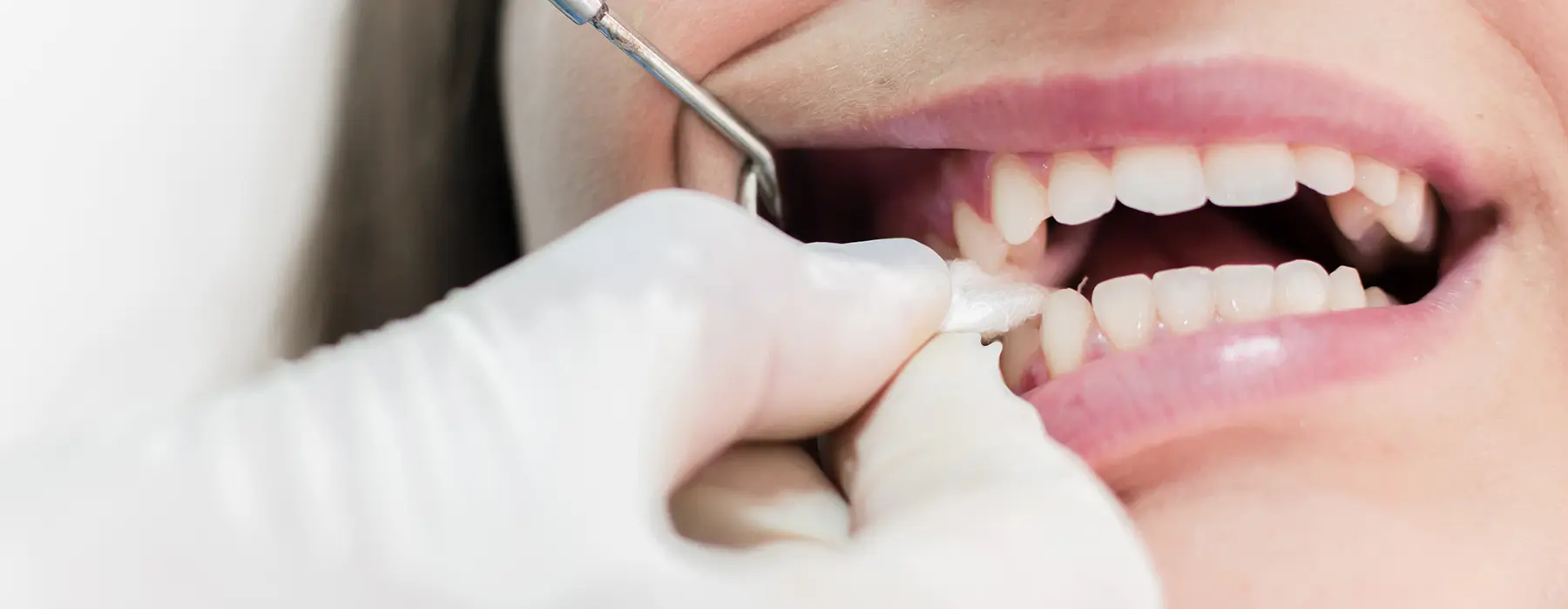 How Long to Keep Gauze in After Tooth Extraction