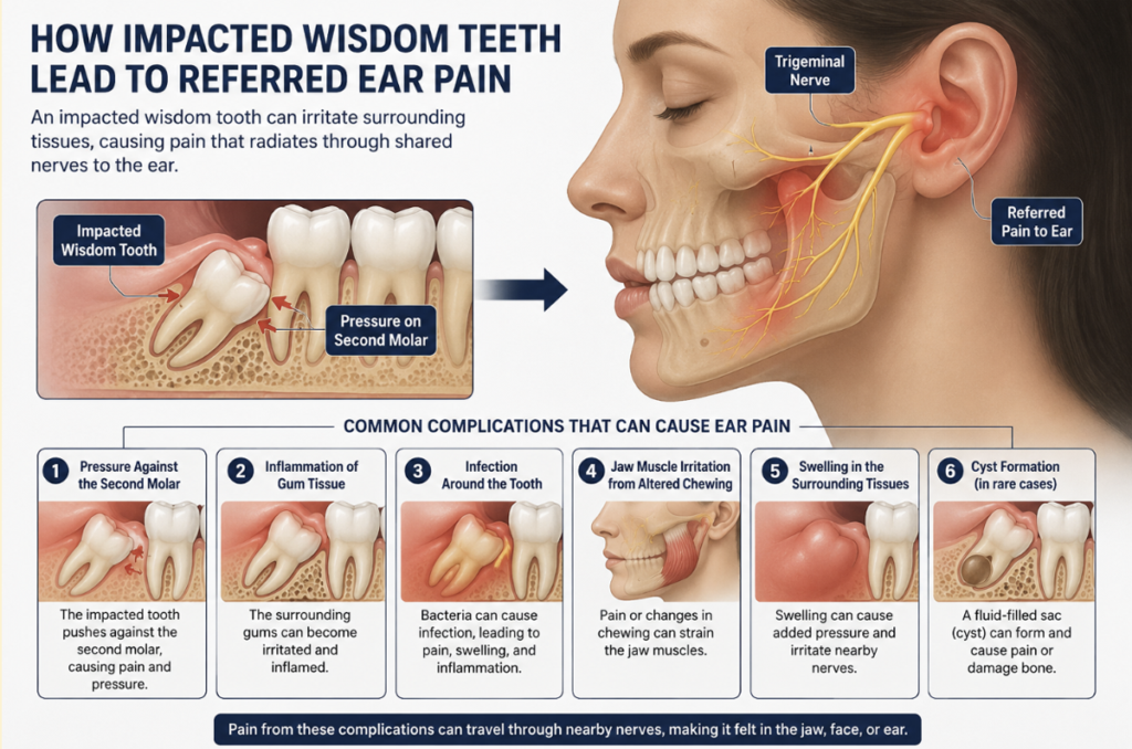 Medical infographic showing how an impacted wisdom tooth can cause referred ear pain through pressure, inflammation, infection, and irritation of nearby nerves and tissues.