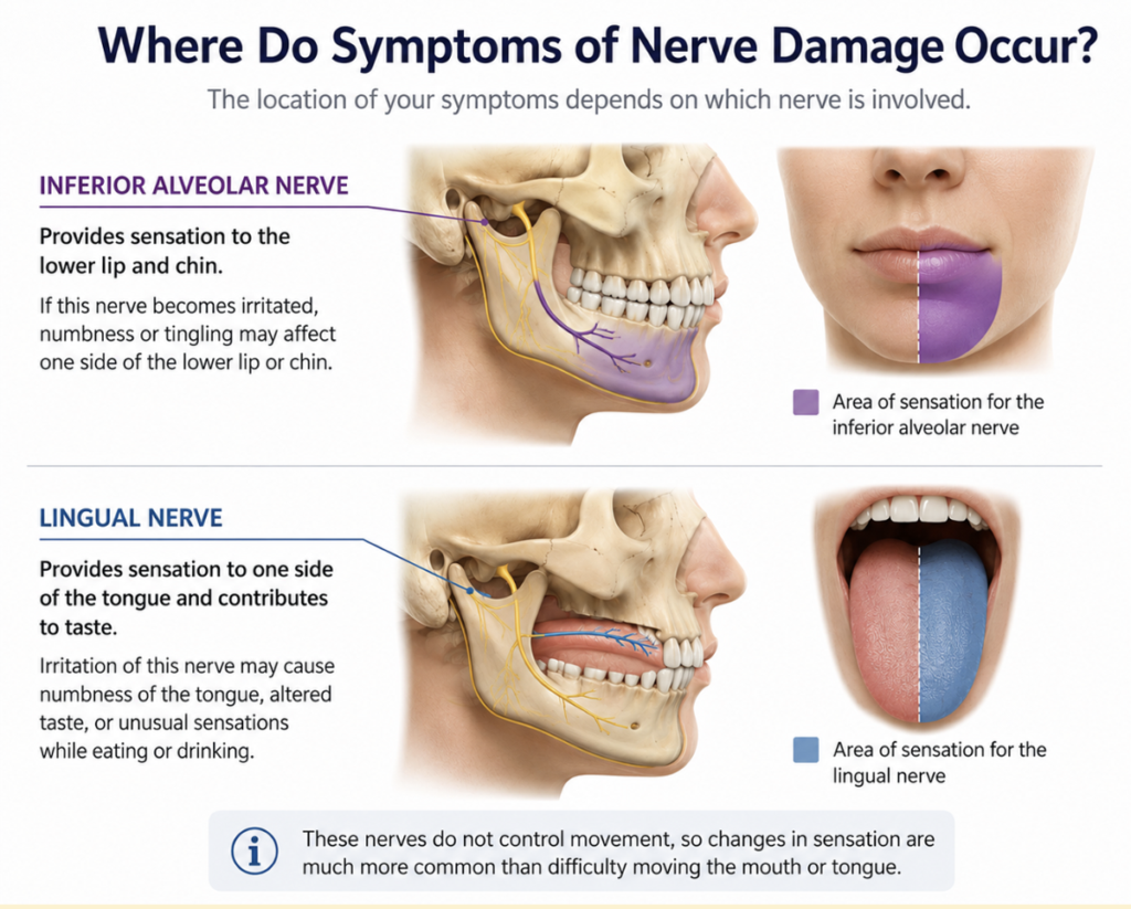 Diagram showing the areas affected by the inferior alveolar and lingual nerves after wisdom tooth removal.