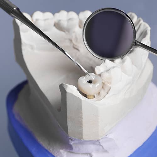 Model of a tooth removal using multiple dental tools