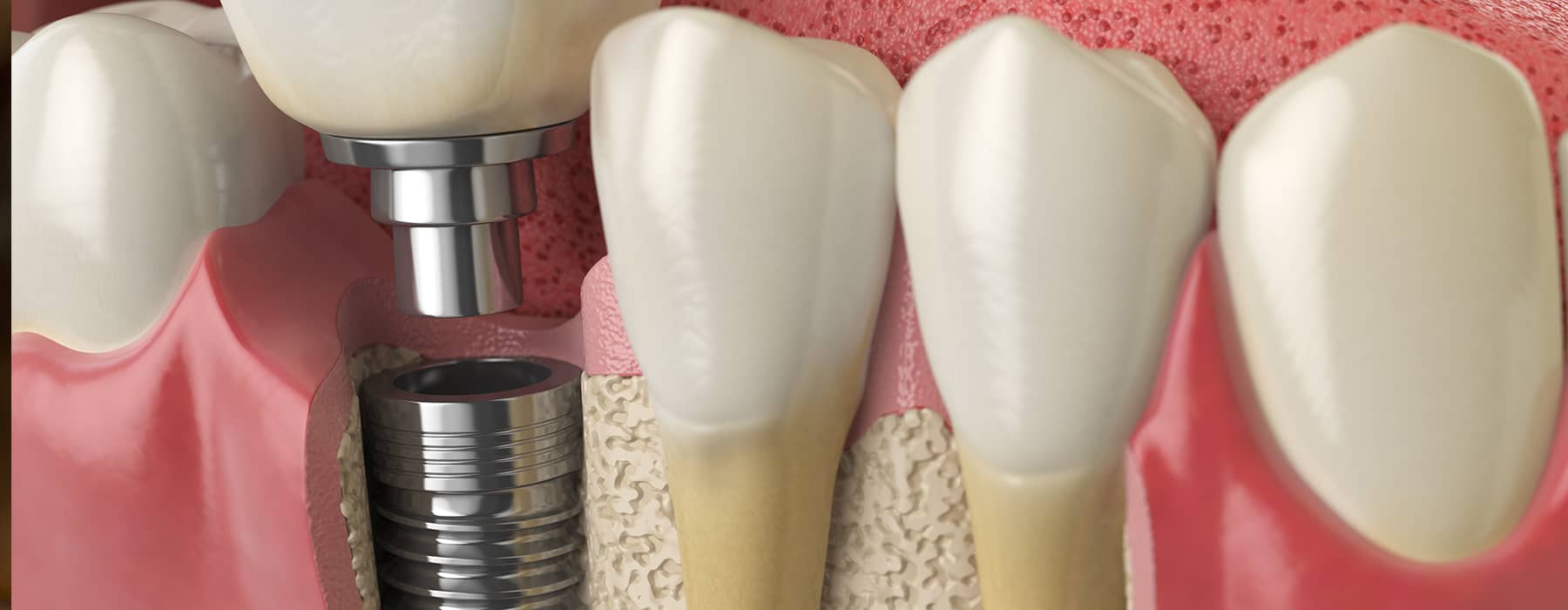 Five Reasons You Should Consider Dental Implants