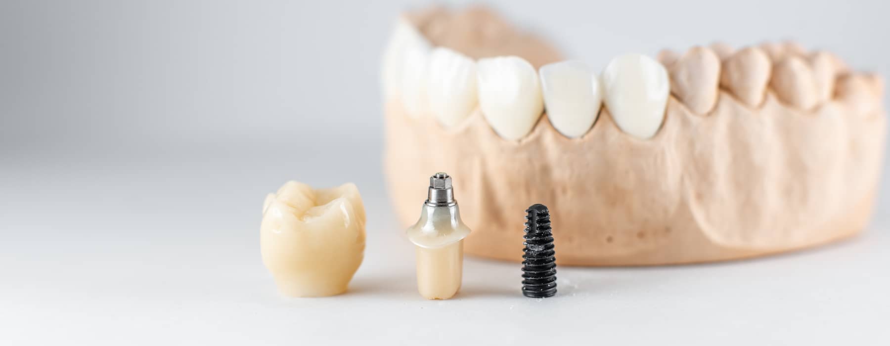 Exploring the Various Types of Dental Implants: Which One is Right for You?