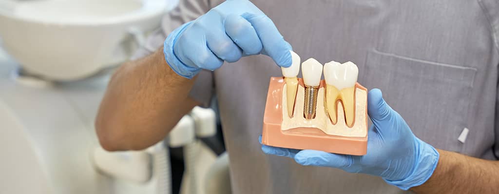 Dental Implants: Their Role in Denture Retention