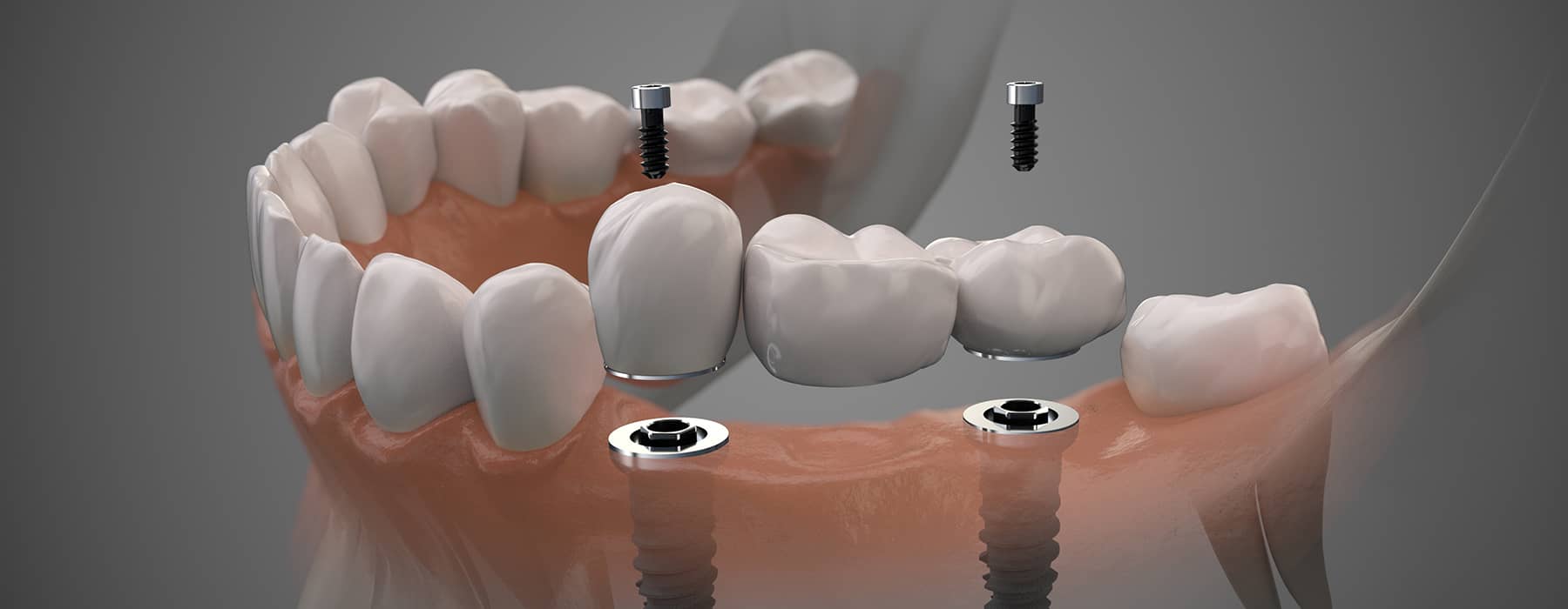 Discover the Benefits of Multi-Implant Bridges for Your Dental Restoration