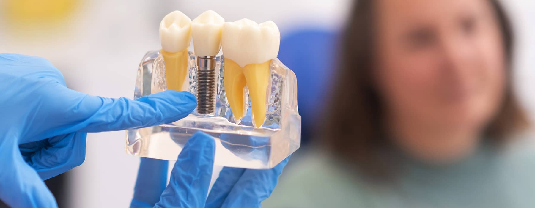 Dental Implant Parts: What Are the 3 Components of Dental Implants