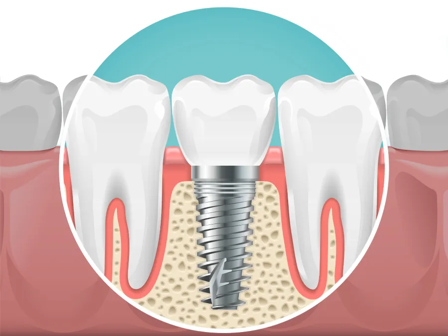Dental Implants Graph AZ Max Dental