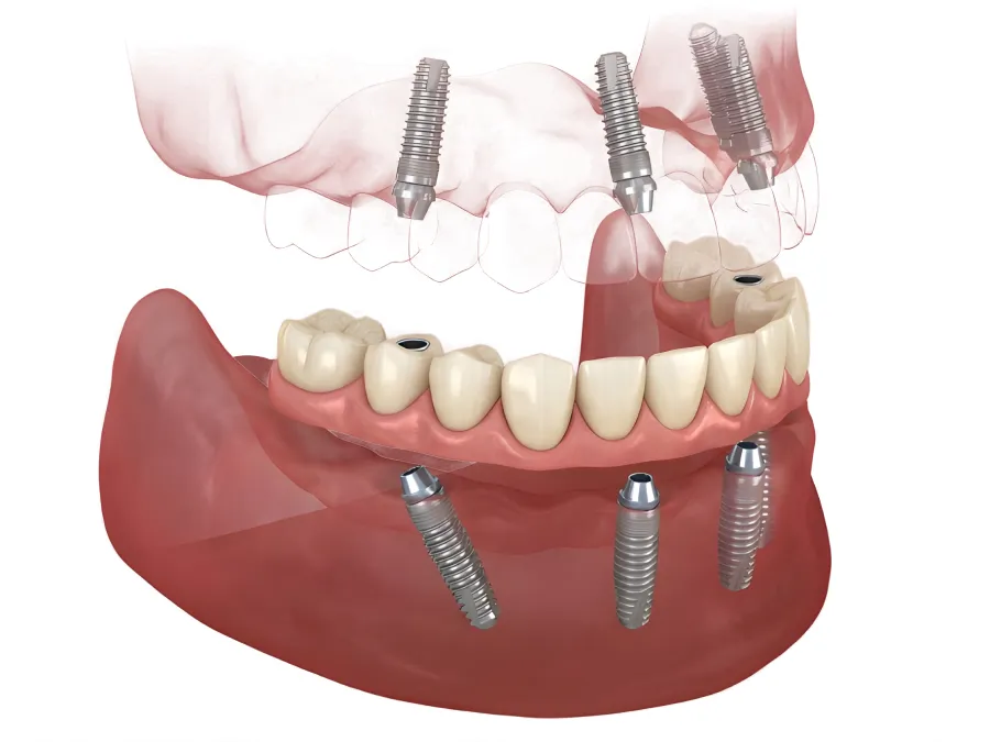 Full-Arch Dental Implants graph