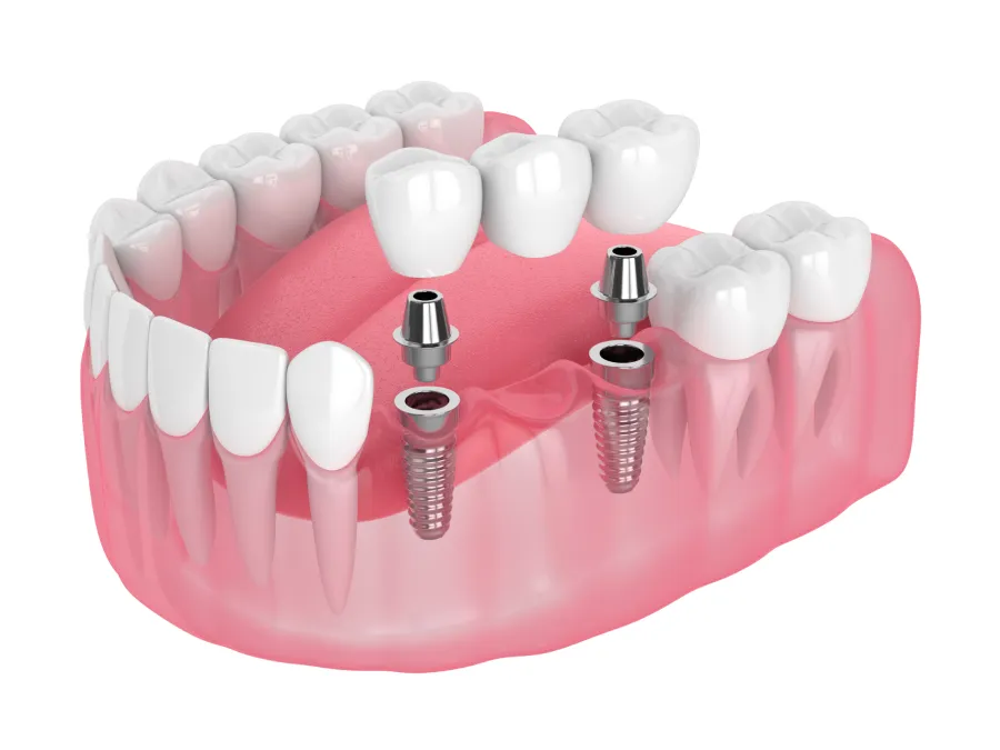 Implant-Supported Dental Bridge graph